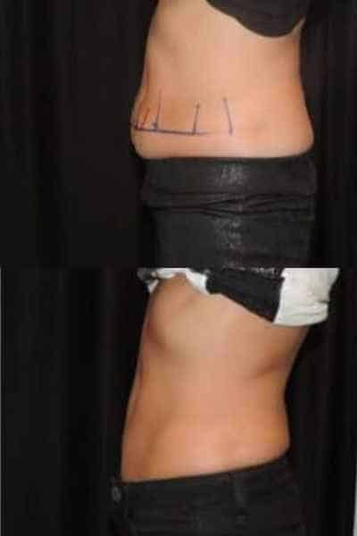 HIEMT Muscle Toning Bedfordshire