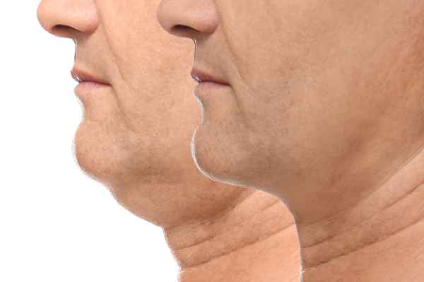HIFU - Breakthrough in Anti - ageing 2 hifu results Bedfordshire