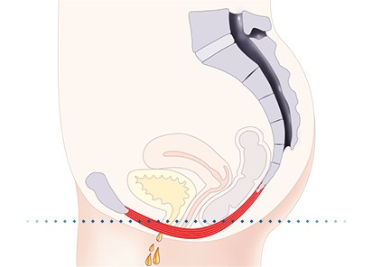 Pelvic-Floor Muscle Repair 5 Pelvic floor muscles Bedfordshire