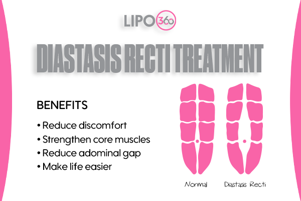 Revolutionising Muscle Repair: The Power of LIPO360 Body Sculpt Post-Injury 5 diastasis recti treatment Bedfordshire