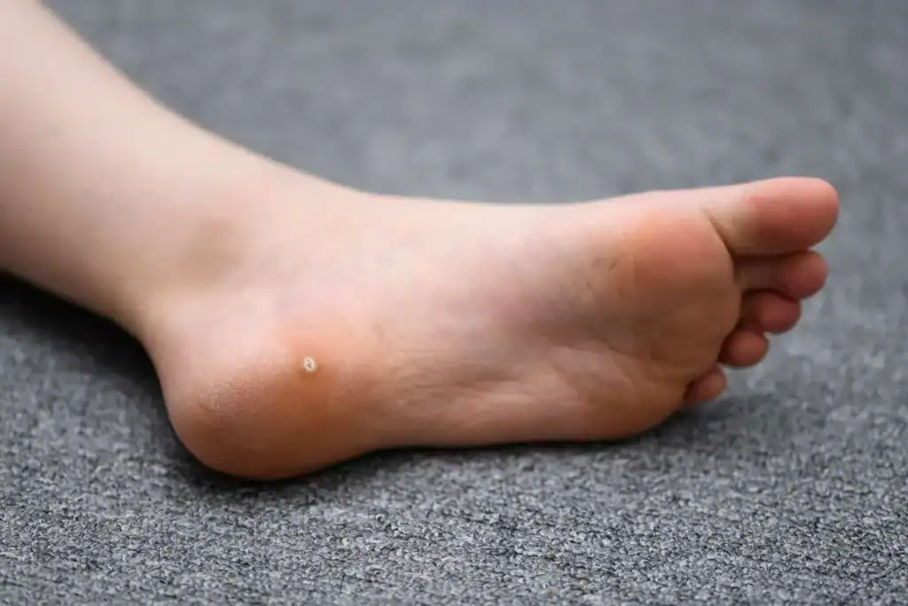 Cryotherapy For Warts And Also Verrucas 2 Image of verruca on the bottom of the foot that able to be treated with Cryotherapy Bedfordshire