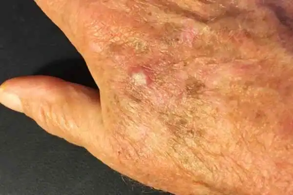 Image of Actinic keratoses Bedfordshire on a person hand