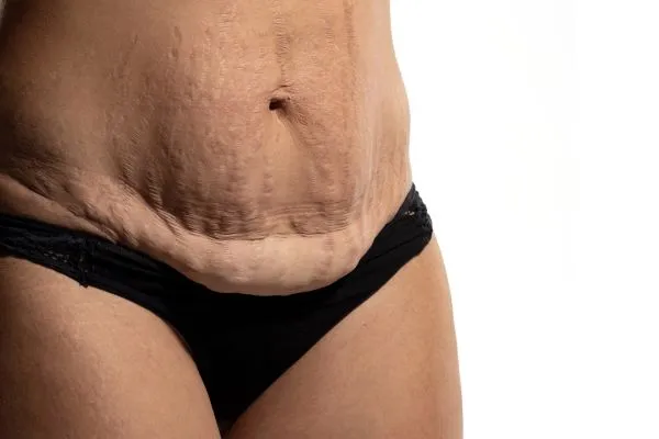 The science behind skin tightening Bedfordshire picture of a woman's sagging skin on the stomach